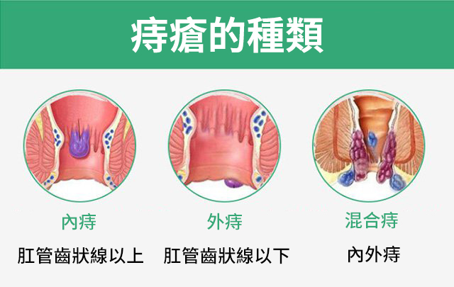 1635484676 7 EELHOE天然草藥噴霧舒緩腫脹痔